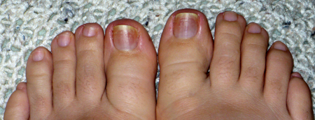 The beginnings of Black Toenail