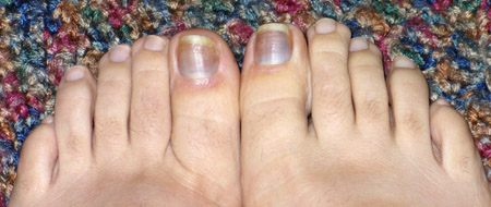 Minor case of black toenails