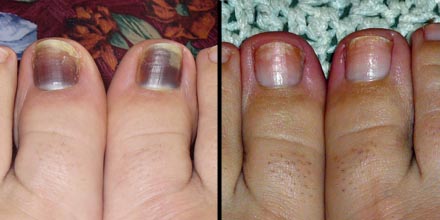Black Toenail: Before and After